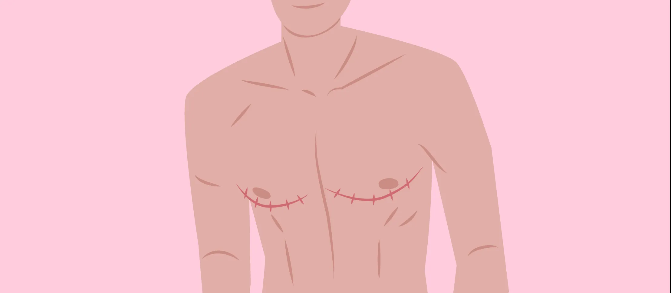 Critical Appraisal of “Long-Term Regret and Satisfaction With Decision Following Gender-Affirming Mastectomy"