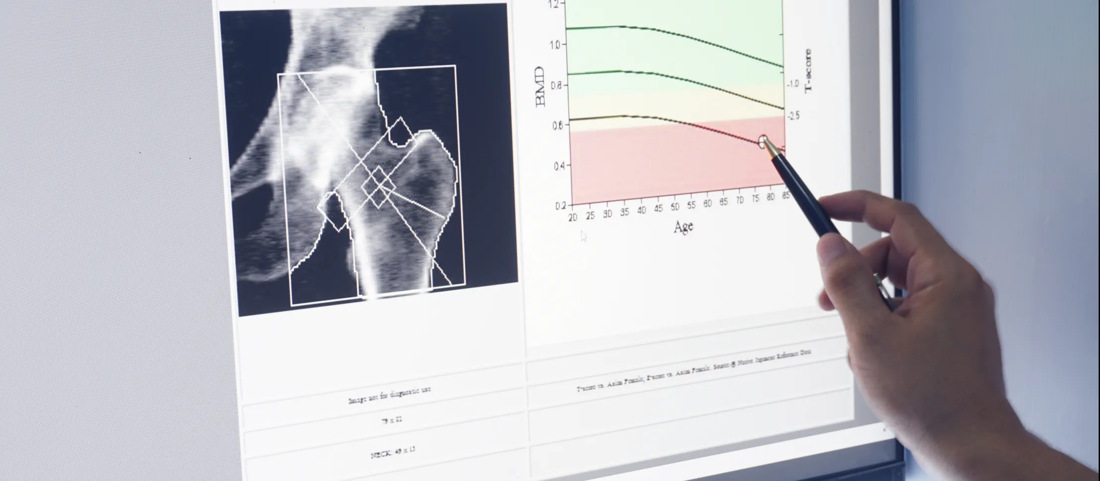 The Effect of Puberty Blockers on the Accrual of Bone Mass